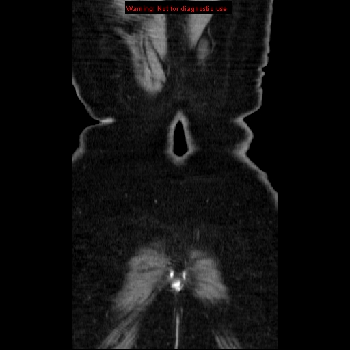 File:Acute appendicitis complicated by ovarian vein thrombophlebitis (Radiopaedia 16172-15851 Coronal C+ portal venous phase 82).jpg