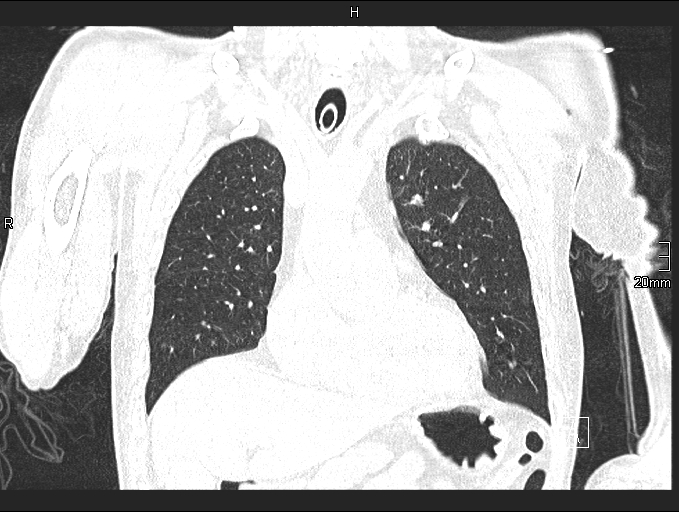 Acute aspiration pneumonitis (Radiopaedia 55642-62166 Coronal lung window 32).jpg