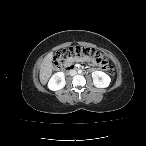 Acute bilateral pyelonephritis (Radiopaedia 37146-38881 Axial C+ portal venous phase 50).jpg