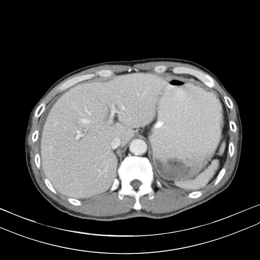 Acute bowel ischemia (Radiopaedia 87695-104114 Axial C+ portal venous phase 20).jpg