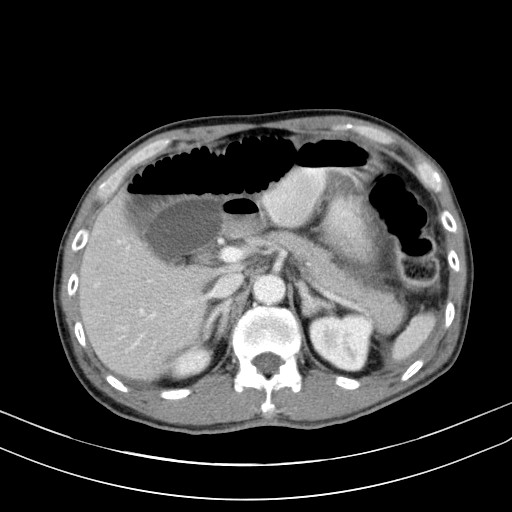 Acute bowel ischemia (Radiopaedia 87695-104114 Axial C+ portal venous phase 26).jpg