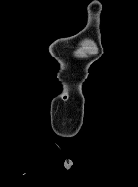 Acute bowel ischemia (Radiopaedia 87695-104114 Coronal C+ portal venous phase 55).jpg