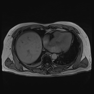 Acute cholecystitis (Radiopaedia 72392-82923 Axial T1 out-of-phase 17).jpg