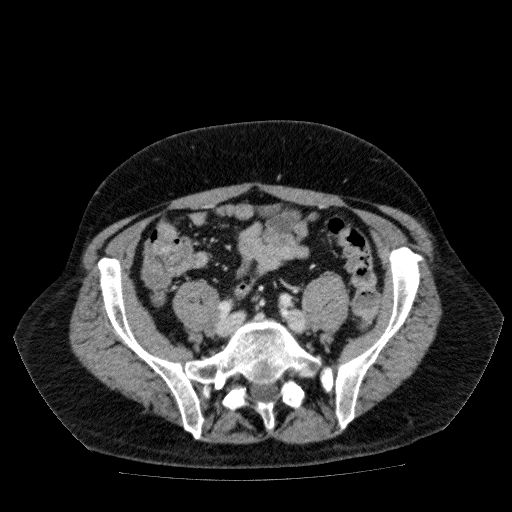 Acute cholecystitis and incidental left sided IVC (Radiopaedia 49352-54459 Axial C+ portal venous phase 111).jpg
