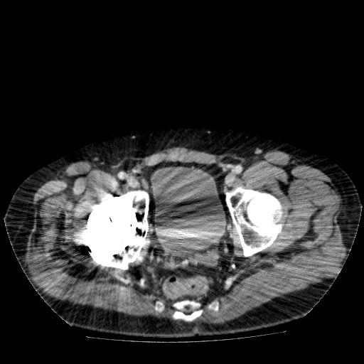 File:Acute cholecystitis and incidental left sided IVC (Radiopaedia 49352-54459 Axial C+ portal venous phase 144).jpg