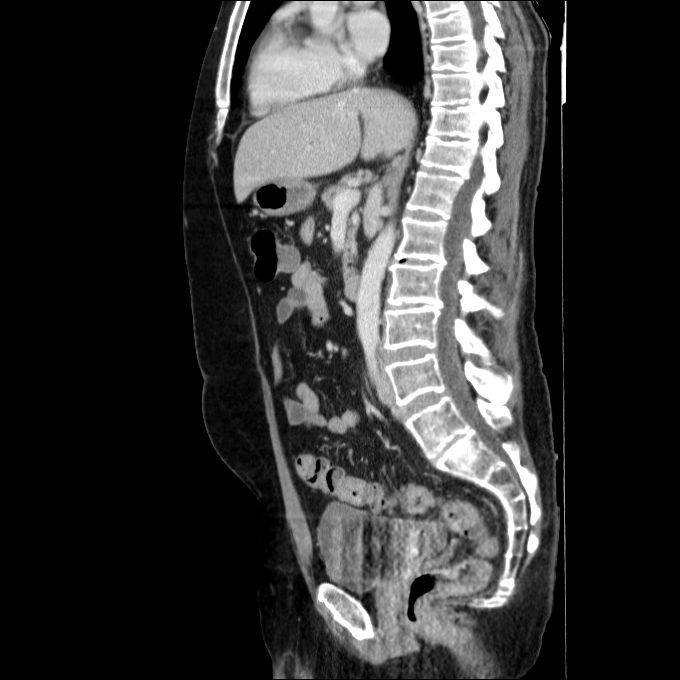 Acute cholecystitis and incidental left sided IVC (Radiopaedia 49352-54459 Sagittal C+ portal venous phase 47).jpg