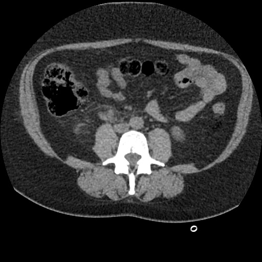Acute cholecystitis and ureteric colic (Radiopaedia 42330-45444 Axial prone 58).jpg