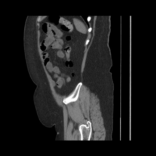 Acute cholecystitis with tensile fundus sign (Radiopaedia 71394-81723 Sagittal non-contrast 136).jpg