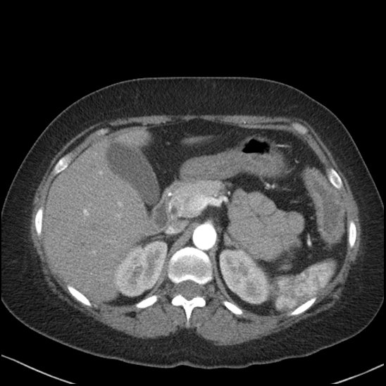 Acute colonic hemorrhage in ulcerative colitis (Radiopaedia 77415-89538 Axial C+ arterial phase 38).jpg