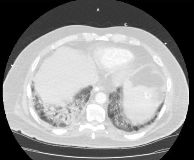 Acute cor pulmonale (ultrasound) (Radiopaedia 83508-98818 Axial lung window 69).jpg