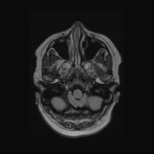 Acute disseminated encephalomyelitis (ADEM) (Radiopaedia 38073-40065 Axial FLAIR 15).png