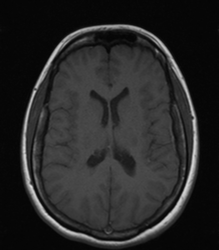 File:Acute disseminated encephalomyelitis (ADEM) (Radiopaedia 65319-74348 Axial C+ delayed 32).png