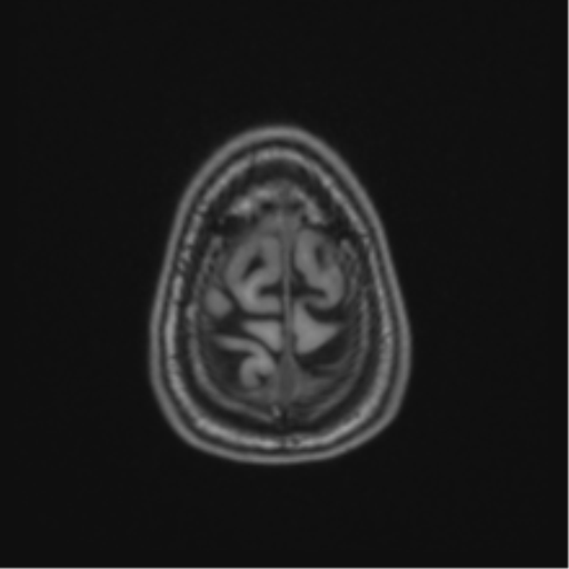 Acute disseminated encephalomyelitis (ADEM) (Radiopaedia 65319-74349 Axial T1 63).png