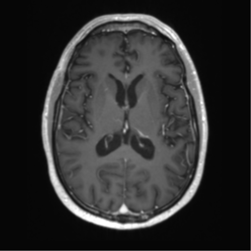 Acute disseminated encephalomyelitis (ADEM) (Radiopaedia 65319-74350 Axial T1 C+ 34).png