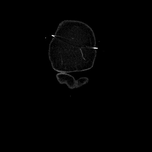 Acute diverticulitis - transverse colon (Radiopaedia 87063-103327 Coronal C+ portal venous phase 12).jpg