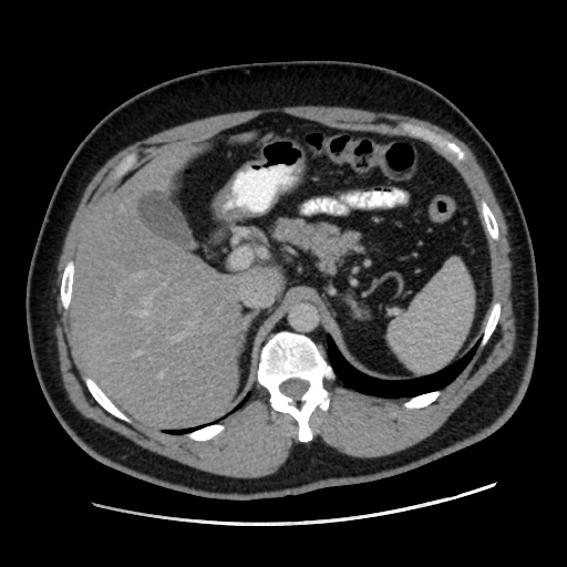 Acute diverticulitis with localized perforation (Radiopaedia 41296-44113 Axial C+ portal venous phase 25).jpg