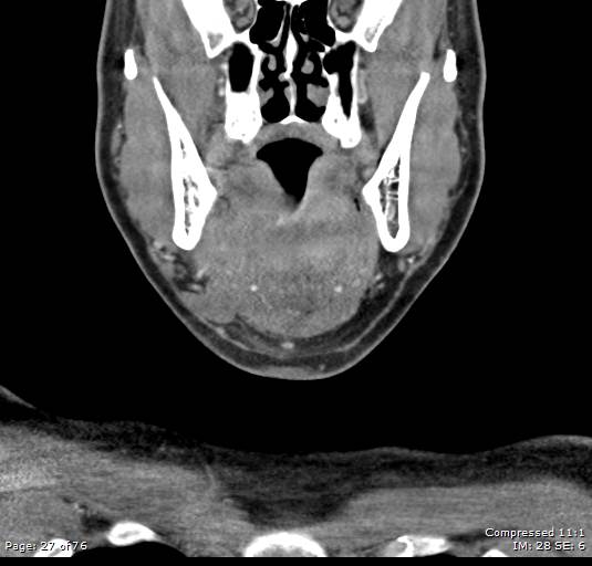 Acute epiglottitis (Radiopaedia 54375-60590 Coronal C+ arterial phase 27).jpg