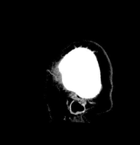 Acute internal carotid artery dissection (Radiopaedia 53541-59558 Sagittal non-contrast 60).jpg