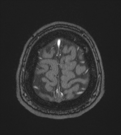 Acute left middle cerebral artery territory infarct with clot retrieval (Radiopaedia 47732-52433 Axial MRA 62).png