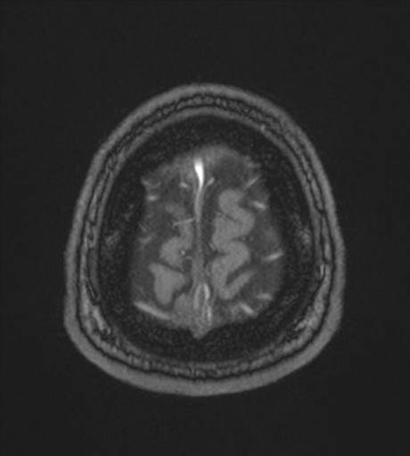 Acute left middle cerebral artery territory infarct with clot retrieval (Radiopaedia 47732-52433 Axial MRA 64).png