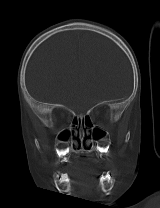Acute mastoiditis (Radiopaedia 82678-96881 Coronal bone window 20).jpg