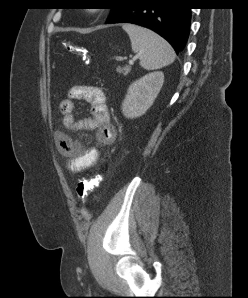 Acute mesenteric venous ischemia (Radiopaedia 46041-50383 Sagittal C+ portal venous phase 91).jpg