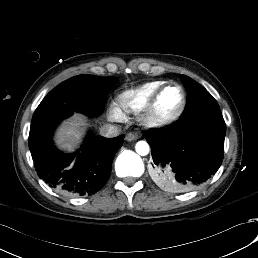 Acute myocardial infarction in CT (Radiopaedia 39947-42415 Axial C+ arterial phase 109).jpg