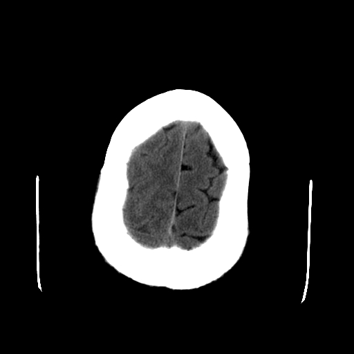 File:Acute necrotizing toxoplasma encephalitis (Radiopaedia 10683-11150 Axial non-contrast 7).jpg