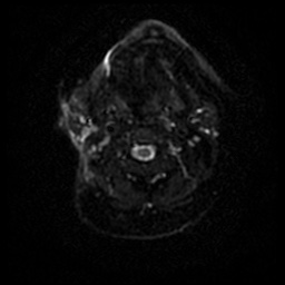 File:Acute otitis externa (Radiopaedia 57296-64236 Axial DWI 46).jpg