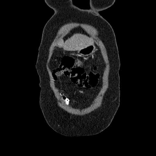 File:Acute pancreatitis (Radiopaedia 20829-20744 Coronal C+ portal venous phase 7).jpg