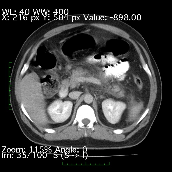 Acute pancreatitis (Radiopaedia 34043-35276 Axial C+ portal venous phase 35).jpg