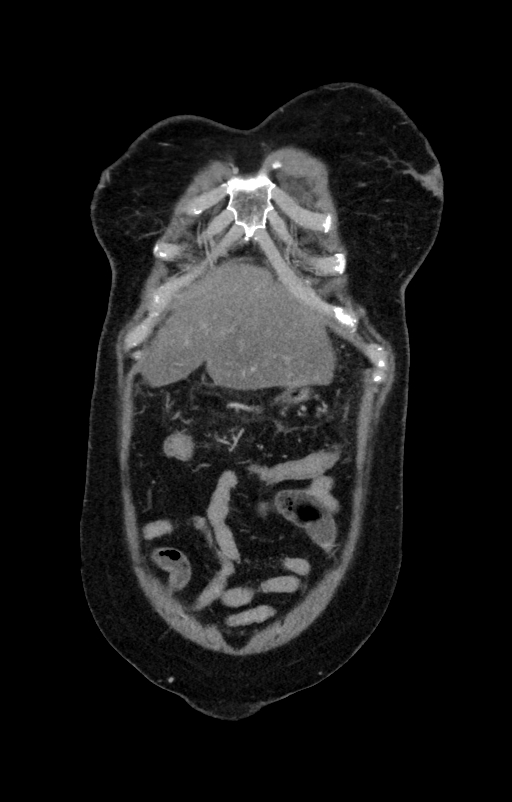 Acute pancreatitis (Radiopaedia 80007-93285 Coronal C+ portal venous phase 16).jpg