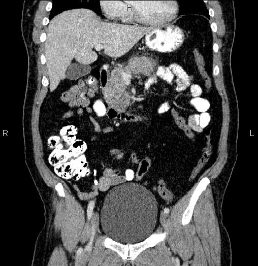 Acute pancreatitis (Radiopaedia 85390-101010 Coronal C+ portal venous phase 27).jpg