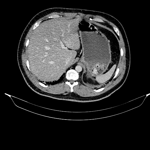File:Acute pancreatitis (Radiopaedia 87428-103757 Axial C+ portal venous phase 25).jpg