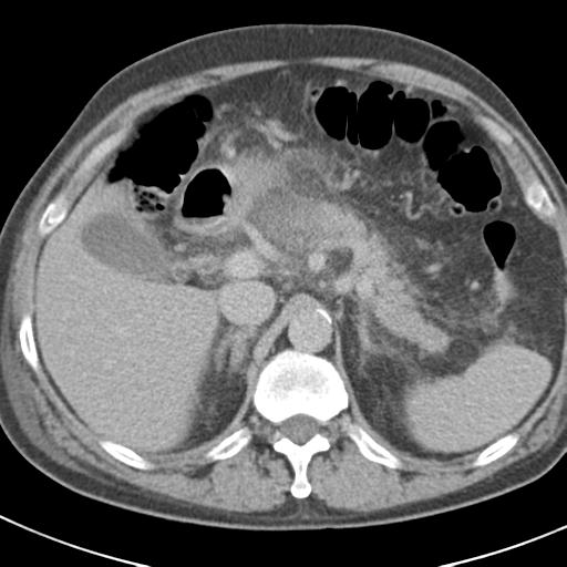 Acute pancreatitis and walled-off necrosis (Radiopaedia 29888-30403 Axial C+ delayed 26).jpg