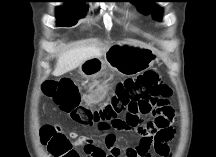 File:Acute pancreatitis and walled-off necrosis (Radiopaedia 29888-30404 Coronal C+ portal venous phase 11).jpg