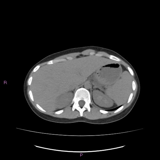 Acute pancreatitis secondary to stone at minor papilla and pancreatic divisum (Radiopaedia 76570-88333 Axial non-contrast 16).jpg