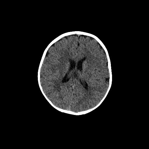 Acute phase of hemiconvulsion-hemiplegia epilepsy syndrome (Radiopaedia 29309-29744 Axial non-contrast 21).jpg
