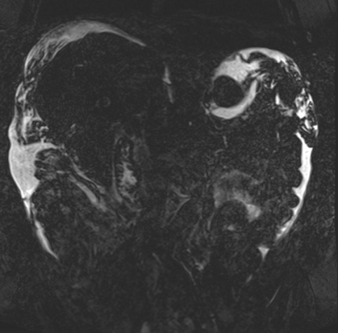 Acute portal vein thrombosis (Radiopaedia 73198-83925 Coronal Heavily T2 thin cuts 46).jpg