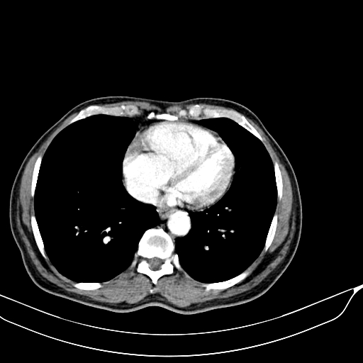 Acute pulmonary embolism (Radiopaedia 69510-79390 D 59).jpg