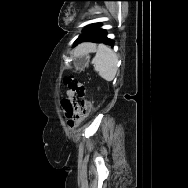 Acute pyelonephritis (Radiopaedia 25657-25837 Sagittal renal parenchymal phase 65).jpg