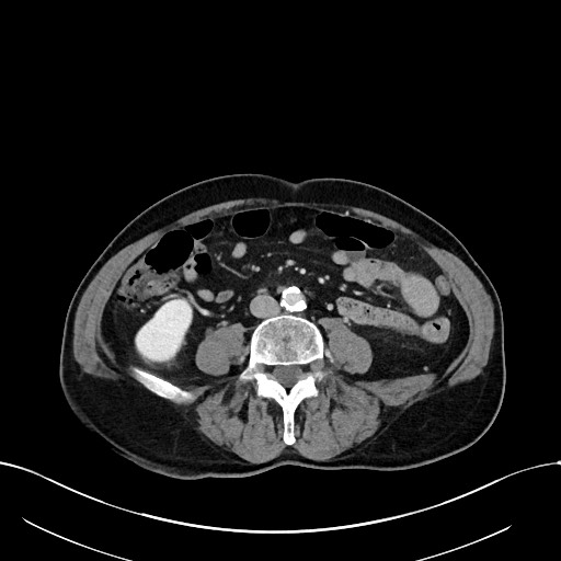 Acute renal infarction (Radiopaedia 59375-66736 Axial C+ portal venous phase 61).jpg