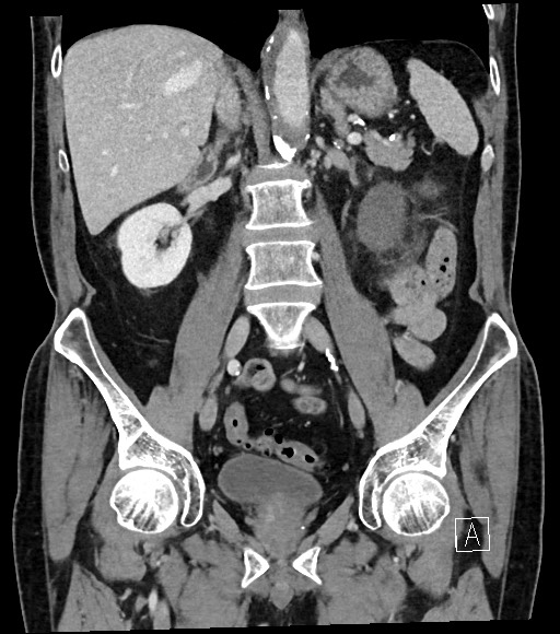 Acute renal infarction (Radiopaedia 59375-66736 Coronal C+ portal venous phase 35).jpg