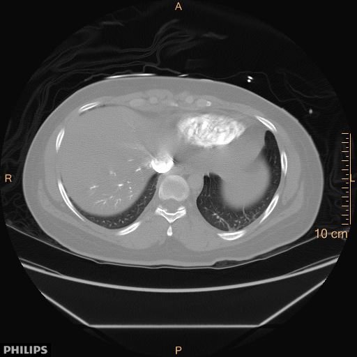 File:Acute reversible pulmonary hypertension and right heart failure from cocaine toxicity (Radiopaedia 49394-54517 Axial 6).jpg