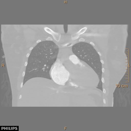 File:Acute reversible pulmonary hypertension and right heart failure from cocaine toxicity (Radiopaedia 49394-54517 Coronal C+ CTPA 14).jpg