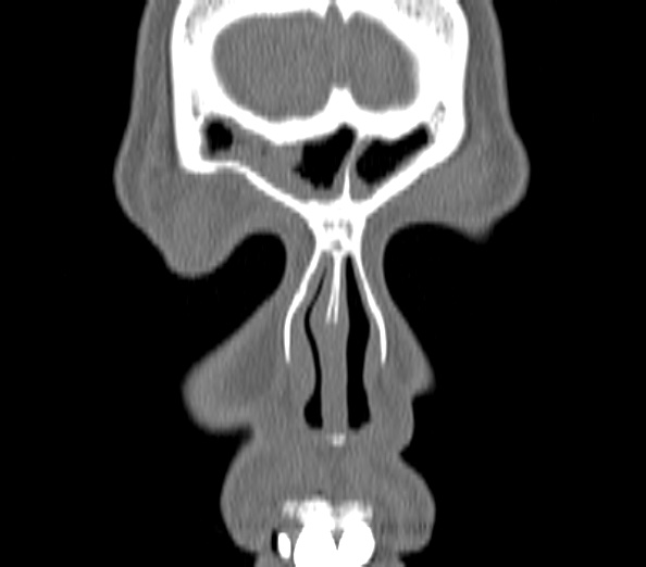 File:Acute sinusitis (Radiopaedia 40564-43158 Coronal bone window 1).jpg