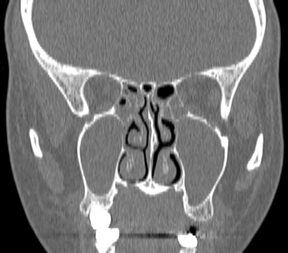 File:Acute sinusitis (Radiopaedia 40564-43158 Coronal bone window 24).jpg