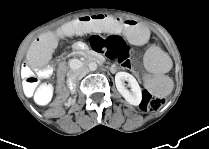 Acute small bowel (ileal) volvulus (Radiopaedia 71740-82139 Axial C+ portal venous phase 93).jpg