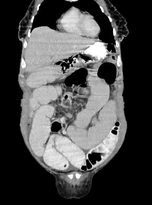 Acute small bowel (ileal) volvulus (Radiopaedia 71740-82139 Coronal C+ portal venous phase 28).jpg