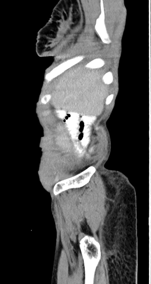 Acute small bowel (ileal) volvulus (Radiopaedia 71740-82139 Sagittal C+ portal venous phase 145).jpg